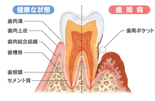 歯を失う原因のトップ