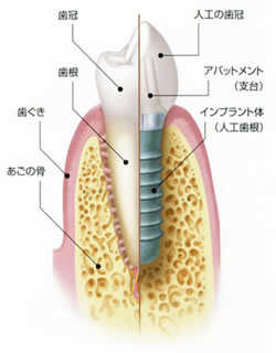 インプラントの構造