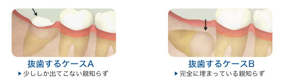 親知らずの抜歯