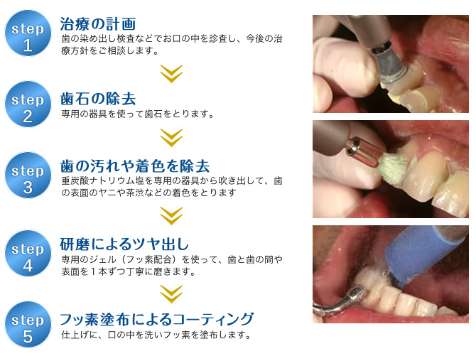 PMTC（歯のクリーニング）